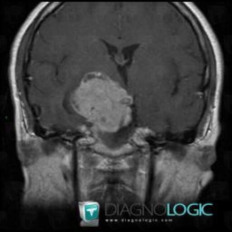 Radiology case : Pituitary macroadenoma (MRI) - Diagnologic