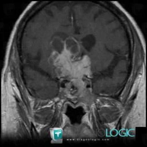 Pituitary macroadenoma, Cerebral hemispheres, MRI