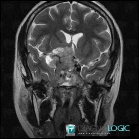 Radiology case : Pituitary macroadenoma (MRI) - Diagnologic