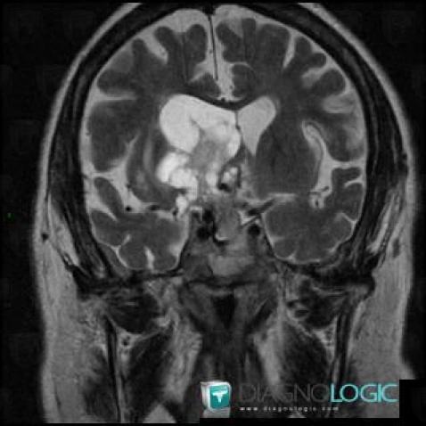 Pituitary macroadenoma, Cerebral hemispheres, Ventricles / Periventricular region, MRI