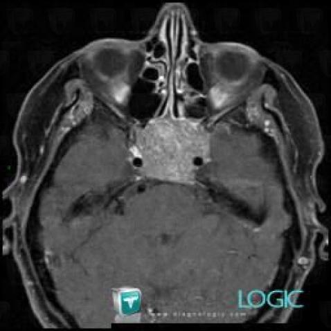 Pituitary macroadenoma, Deep facial spaces, MRI