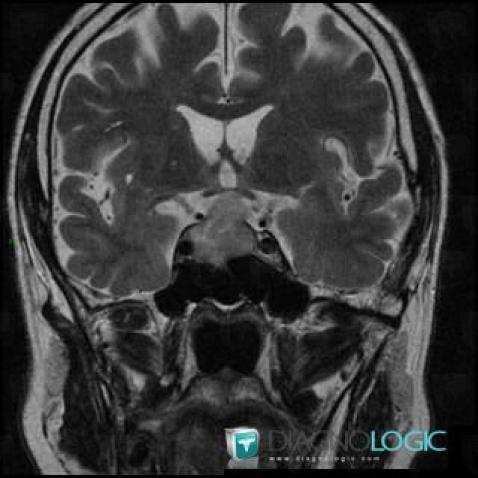 Pituitary macroadenoma, Pituitary gland and parasellar region, MRI