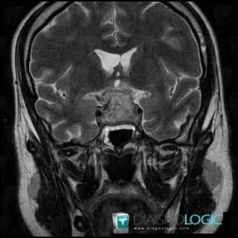 Pituitary macroadenoma, Pituitary gland and parasellar region, MRI