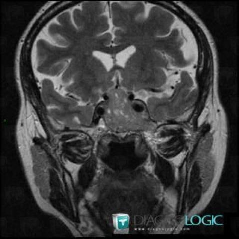 Pituitary macroadenoma, Pituitary gland and parasellar region, MRI