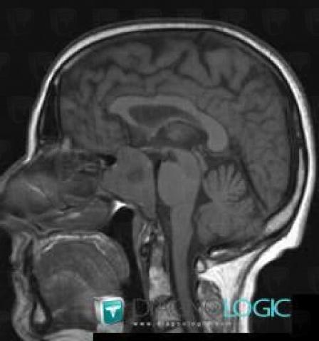 Pituitary macroadenoma, Pituitary gland and parasellar region, MRI