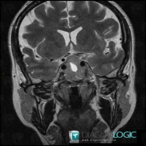 Pituitary macroadenoma, Pituitary gland and parasellar region, MRI