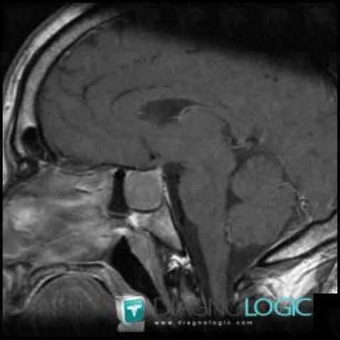 Pituitary macroadenoma, Pituitary gland and parasellar region, MRI