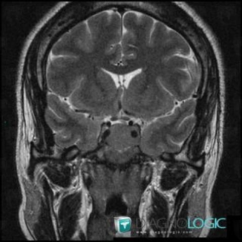 Pituitary macroadenoma, Pituitary gland and parasellar region, MRI