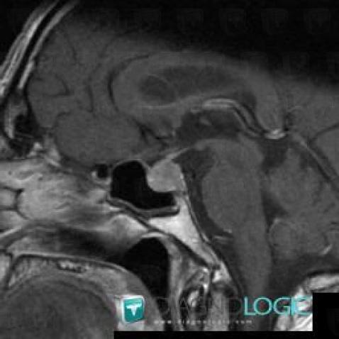 Pituitary macroadenoma, Pituitary gland and parasellar region, MRI