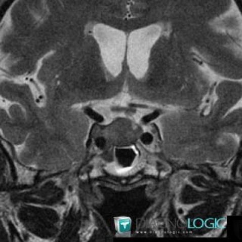 Pituitary macroadenoma, Pituitary gland and parasellar region, MRI