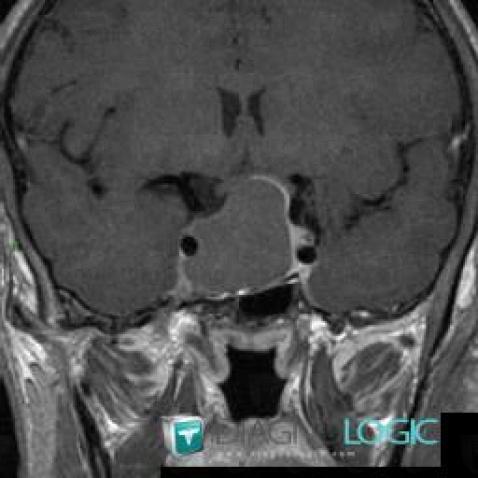 Pituitary macroadenoma, Pituitary gland and parasellar region, MRI