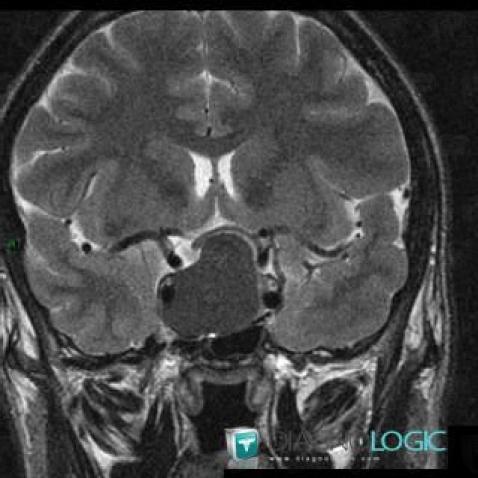 Pituitary macroadenoma, Pituitary gland and parasellar region, MRI