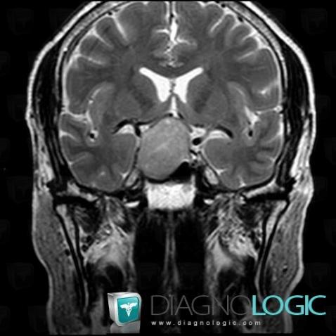 Pituitary macroadenoma, Pituitary gland and parasellar region, MRI