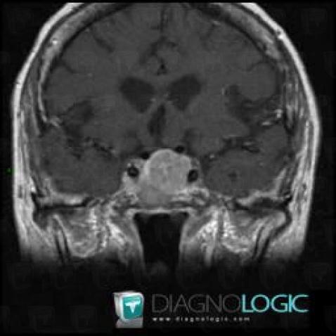 Pituitary macroadenoma, Pituitary gland and parasellar region, MRI