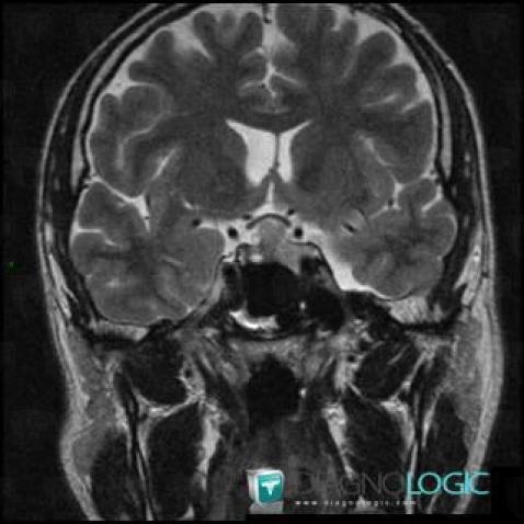 Pituitary macroadenoma, Pituitary gland and parasellar region, MRI