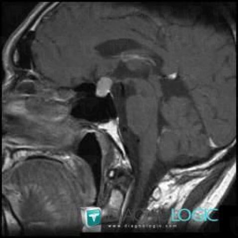 Pituitary macroadenoma, Pituitary gland and parasellar region, MRI