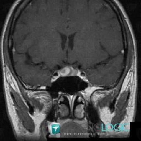 Pituitary macroadenoma, Pituitary gland and parasellar region, MRI