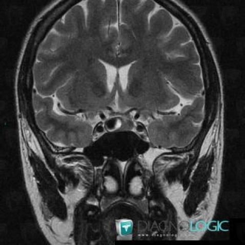 Pituitary macroadenoma, Pituitary gland and parasellar region, MRI