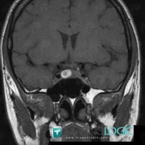 Pituitary macroadenoma, Pituitary gland and parasellar region, MRI