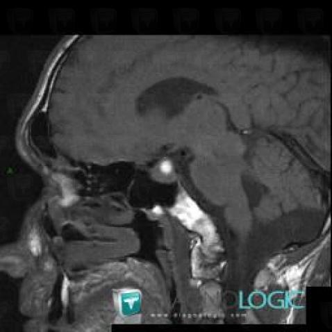 Pituitary macroadenoma, Pituitary gland and parasellar region, MRI