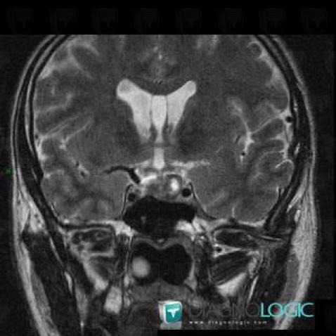 Pituitary macroadenoma, Pituitary gland and parasellar region, MRI