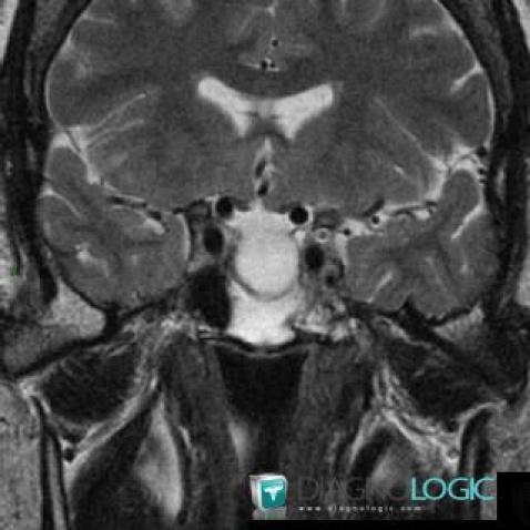 Pituitary macroadenoma, Pituitary gland and parasellar region, MRI