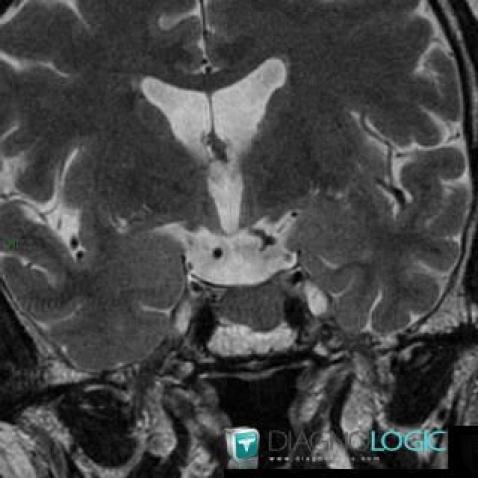 Pituitary macroadenoma, Pituitary gland and parasellar region, MRI