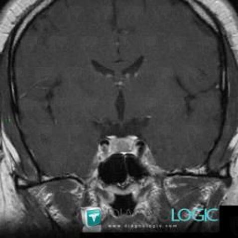 Pituitary macroadenoma, Pituitary gland and parasellar region, MRI