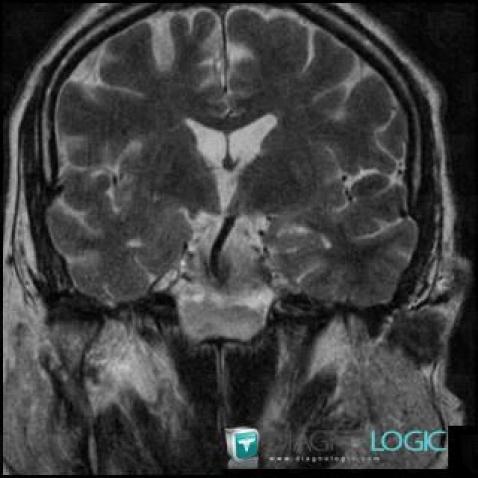 Pituitary macroadenoma, Pituitary gland and parasellar region, MRI