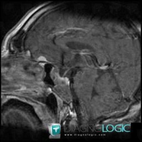 Pituitary macroadenoma, Pituitary gland and parasellar region, Sphenoid bone, MRI