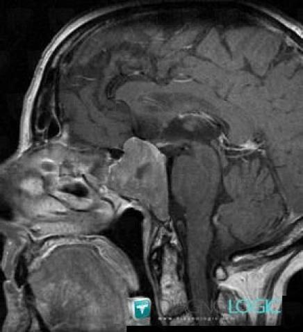 Pituitary macroadenoma, Sinus, MRI