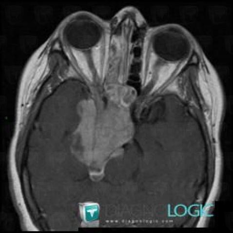 Radiology case : Pituitary macroadenoma (MRI) - Diagnologic