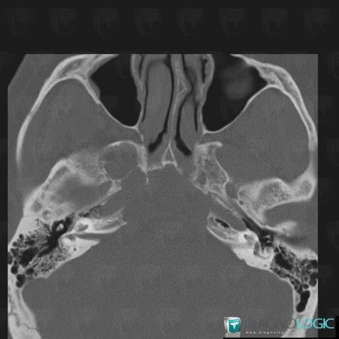 Pituitary macroadenoma, Sphenoid bone, CT