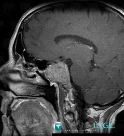 Pituitary macroadenoma, Sphenoid bone, MRI