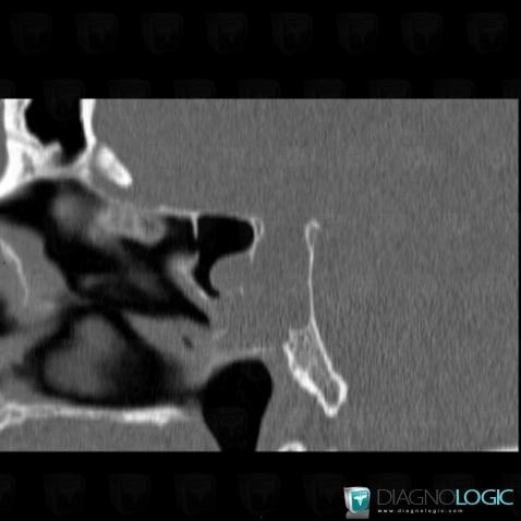 Pituitary macroadenoma, Sphenoid bone, Sinus, CT