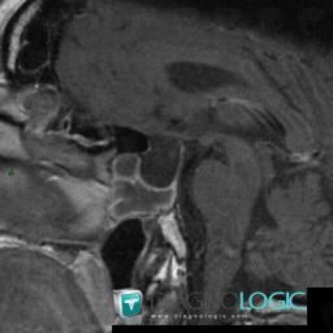 Pituitary macroadenoma, Sphenoid bone, Sinus, MRI