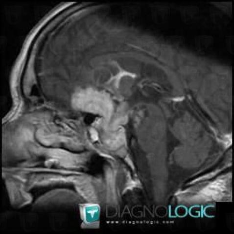 Pituitary macroadenoma, Supratentorial peri cerebral spaces, Cerebral falx / Midline, MRI