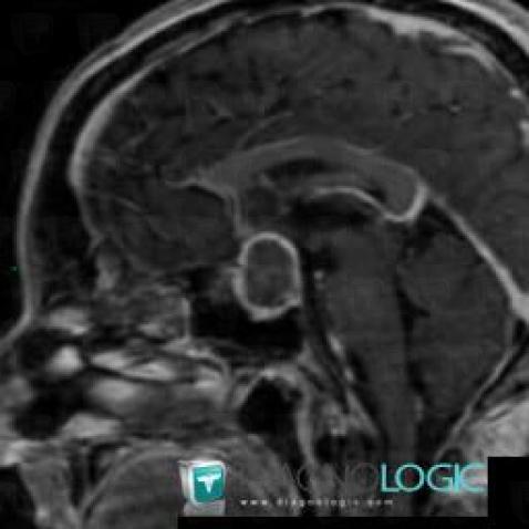 Pituitary macroadenoma, Supratentorial peri cerebral spaces, MRI