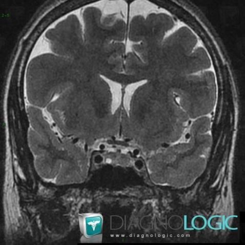 Pituitary microadenoma, Pituitary gland and parasellar region, MRI