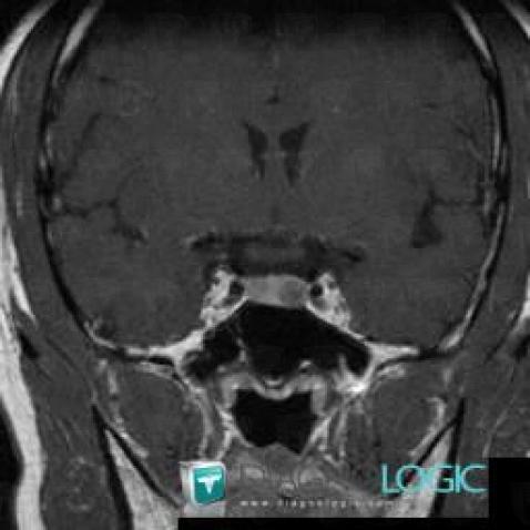 Pituitary microadenoma, Pituitary gland and parasellar region, MRI