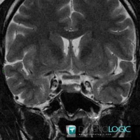 Pituitary microadenoma, Pituitary gland and parasellar region, MRI