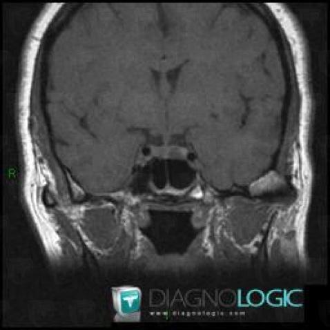 Pituitary microadenoma, Pituitary gland and parasellar region, MRI