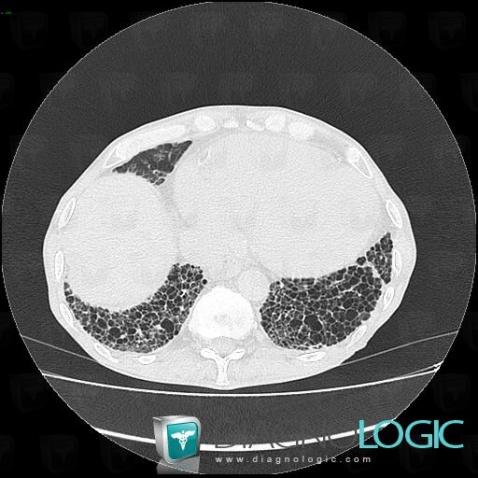 PIU, Parenchyme pulmonaire, Scanner