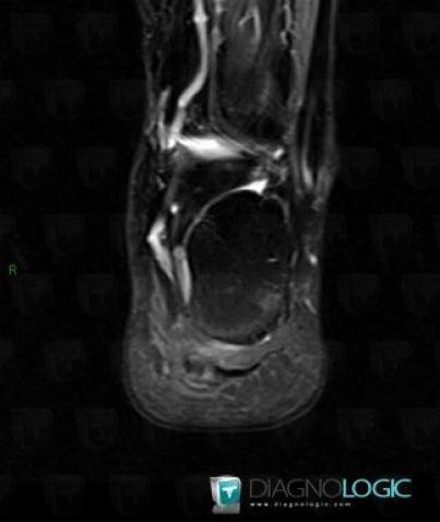 Plantar aponeurosis rupture, Plantar aponeurosis, MRI