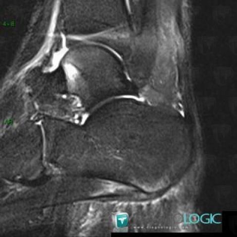 Plantar fasciitis, Plantar aponeurosis, MRI