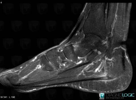 Plantar fasciitis, Plantar aponeurosis, MRI