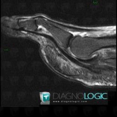 Plantar plate rupture, Other soft tissues/nerves - Foot, MRI