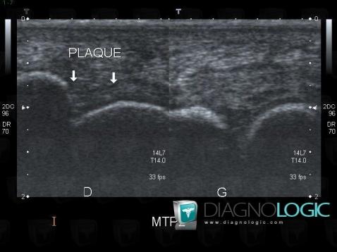 Plantar plate rupture, Other soft tissues/nerves - Foot, US