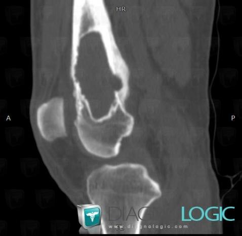 Plasmacytoma, Femur - Distal part, CT