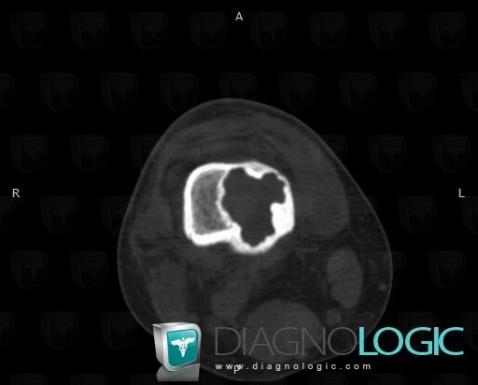 Plasmacytoma, Femur - Distal part, CT